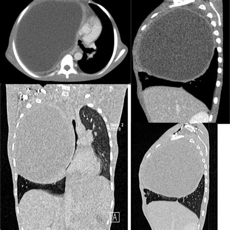 Contrast Enhanced Chest Computed Tomography In Axial Coronal And