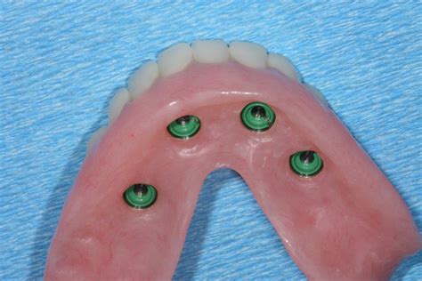 Overdentures Utica Dental Laboratory