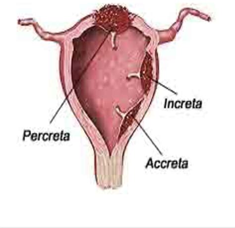 N351 Exam 3 Postpartum Complications Flashcards Quizlet