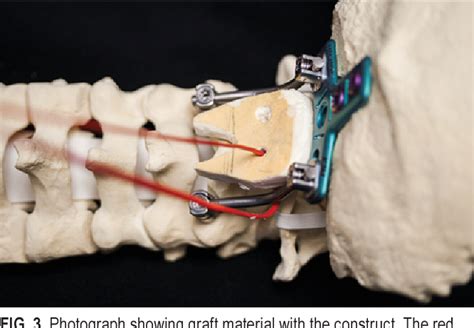 Figure From Comparison Of Structural Allograft And Traditional