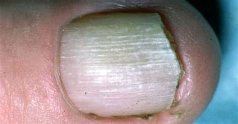 Dermnet Lichen Planus Of Nail Image