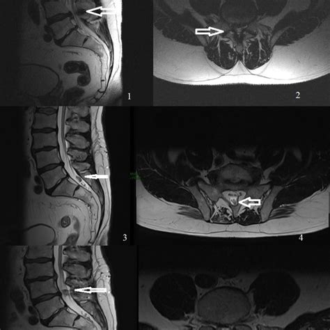 Preoperative MRI Showing A Disc Herniation At Level 4 5 Re 3 4 MRI