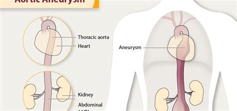 Aortic aneurysm – causes, types, symptoms, treatment. How is an aortic ...