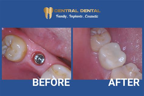 Implant To Replace Molar | Central Dental