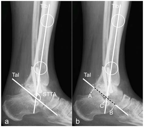 Talus Bone X Ray