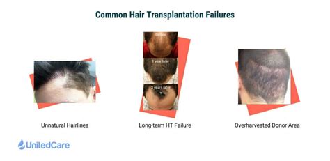 Why A Dermatologist Is Needed In A Hair Transplantation