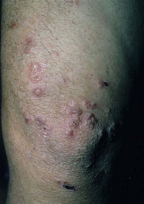 dermatitis herpetiformis pictures - pictures, photos