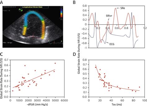 Left Ventricular Diastolic Function Understanding Pathophysiology Diagnosis And Prognosis