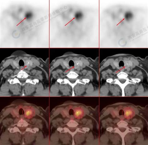 高尚病例：18f Fdg Petct 检查无意中发现的甲状腺癌 4 例 医院汇 丁香园