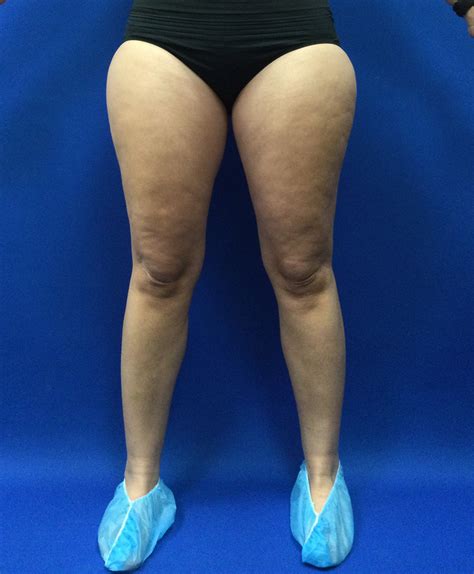 Lipedema Stages - Lipedema MD