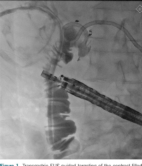 Figure 1 From Endoscopic Ultrasound Guided Gastrojejunostomy And Rescue