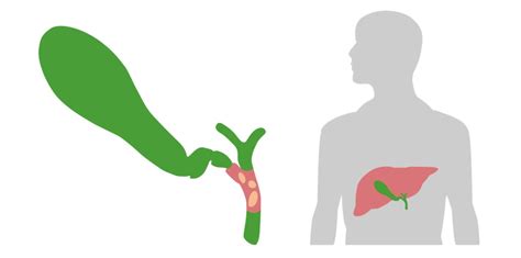 Acute Cholangitis | Concise Medical Knowledge