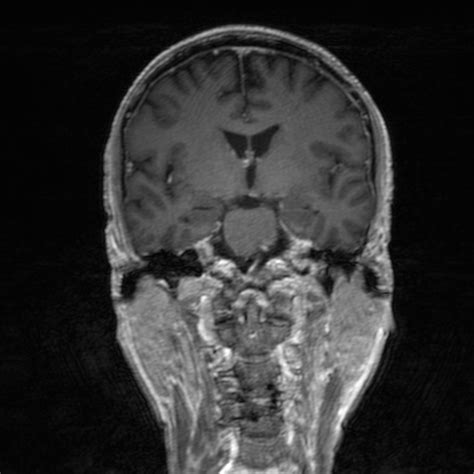 Frontal Mucocele Image