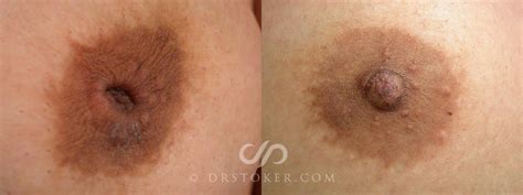 Nipple Inversion Correction Before And After Pictures Case Los