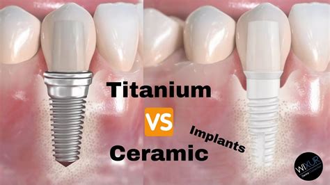 Ceramic Vs Titanium Implants YouTube