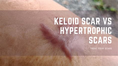 Keloid Scar Vs Hypertrophic Scar - Treat Your Scars