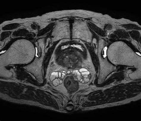 Prostate Lesion With High B Value Dwi Philips Mr Body Map