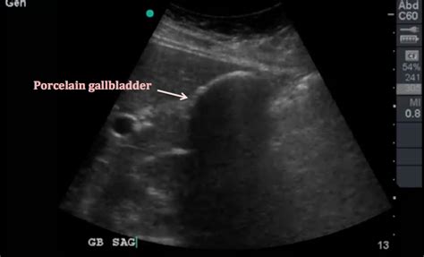 Chronic Cholecystitis Ultrasound Wes Sign