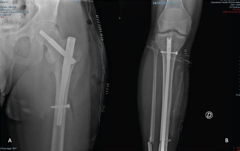 Early And Isolated Cerebral Fat Embolism In A Trauma Patient With