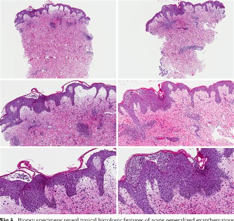 Acute Generalized Exanthematous Pustulosis Induced By Mifepristone