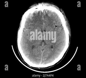 A CT Scan Of The Brain Of A Patient With Traffic Accident Showing Acute