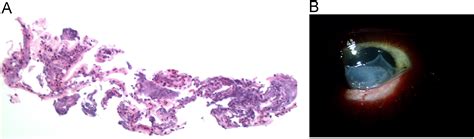 Corneal Melt Following Collagen Crosslinking And Topography Guided