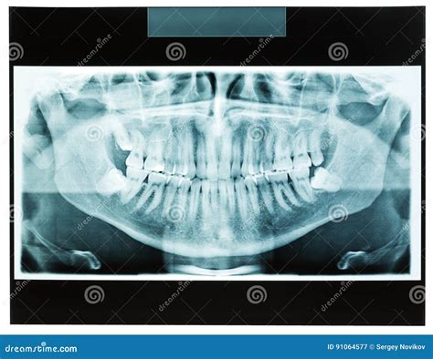 Closeup Of Man Xray Jaw For Dental Teeth Doctor Stock Image Image Of