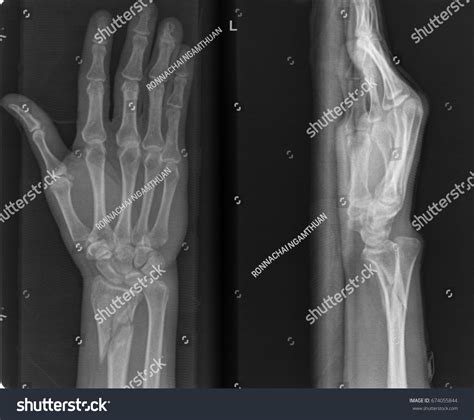 Radiography Hospital Closed Fracture Radius Ulna Stock Photo 674055844 | Shutterstock