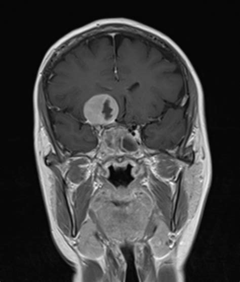 Clinoid Meningioma Image