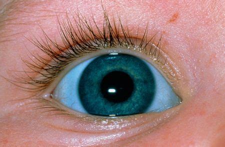 Blue Sclera | Symptoms, Causes, Prevention, and Treatment