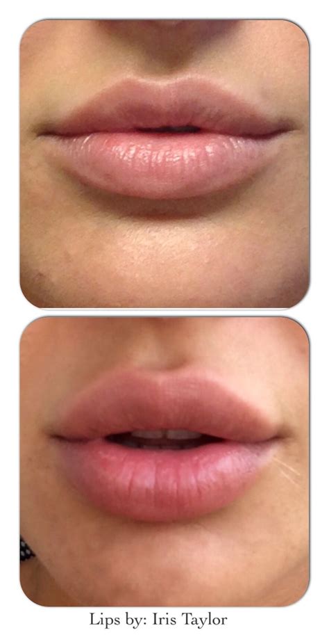 Mybodytonic Botox Fillers Dermal Fillers Lip Fillers