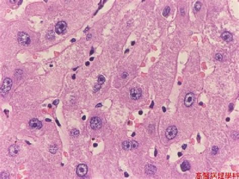 Kmu Pathology Labslide Cirrhosis Postnecrotic Liver