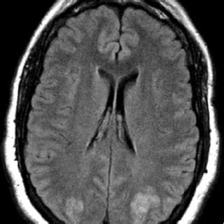 Figure T Weighted Magnetic Resonance Image Obtained Following Case