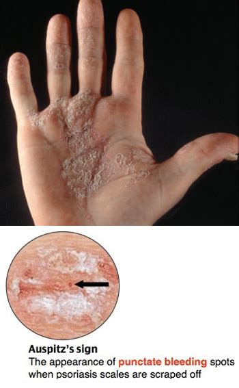 Auspitz sign (punctate bleeding spots below scales): psoriasis, Darier ...