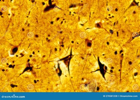 Pyramidal Neuron. Neurofibrillary Tangles Stock Photography ...