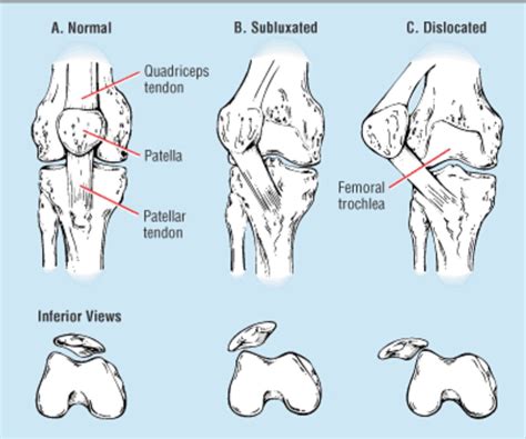 Patellar Dislocation: Treatment Options - Sports Medicine Review