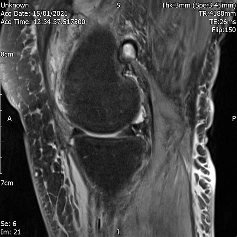 Knee Synovitis | Cases - Home