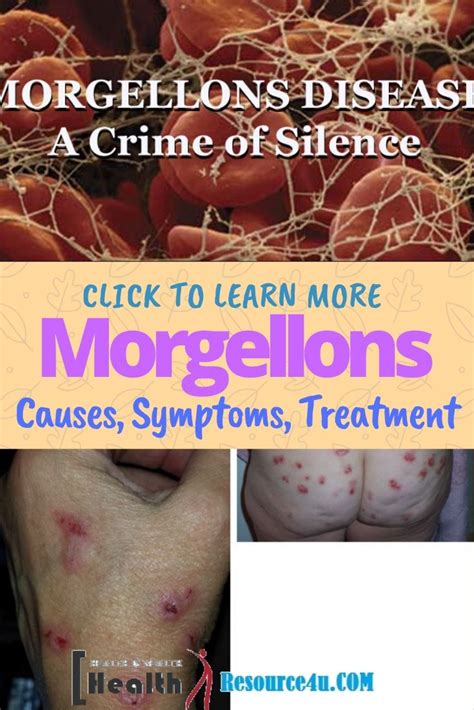 what is morgellons disease Morgellons disease - Diseases Club center