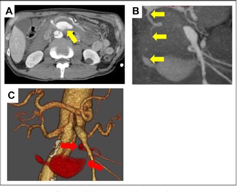 Figure From Transarterial Embolization With Complementary Surgical