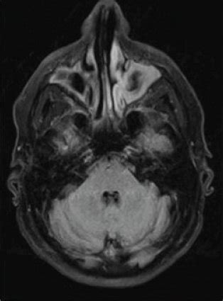 T2 FLAIR Magnetic Resonance Imaging MRI Brain With Contrast