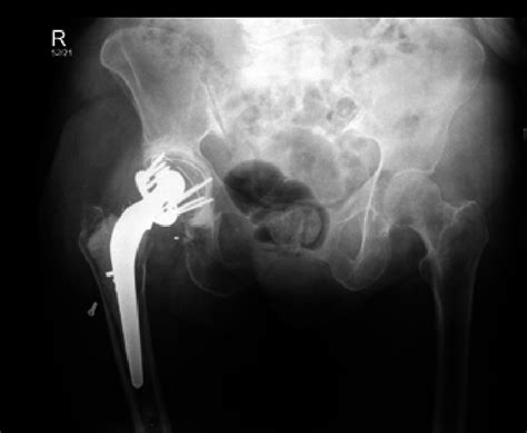 Post Operative Antero Posterior Radiograph Showing The Dual Plad