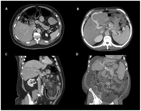 Jcm Free Full Text Portal Vein Thrombosis In The Setting Of