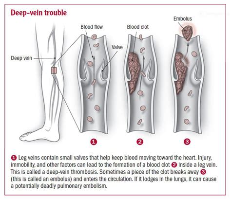 Deep vein thrombosis - Harvard Health