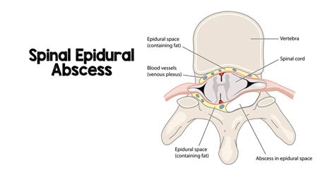 Spinal Epidural Abscess Diagnosis Management And Outcomes Top