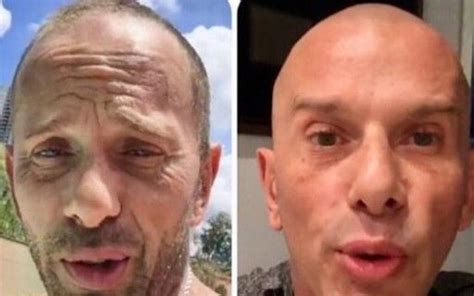 Rafael Ilha Mostra Antes E Depois De Procedimentos Botox E