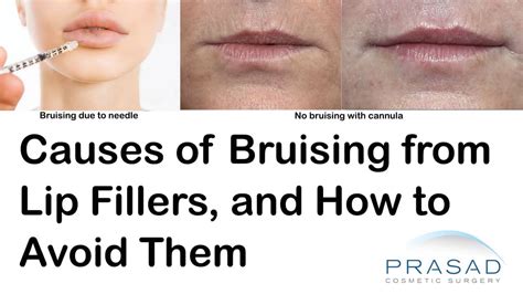 How To Avoid Bruising After Lip Fillers Dr Amiya Prasad Blog