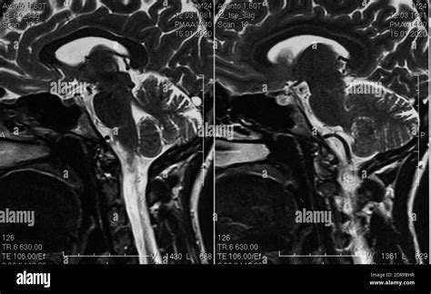 MRI scan of human brain, sagittal view, cerebellum Stock Photo - Alamy