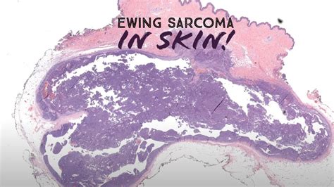 Ewing Sarcoma Arising In Skin Australasian Dermpath 2022 Case 6 Pathology Dermatology