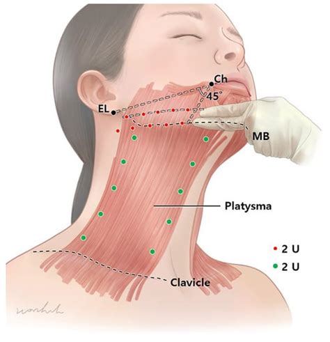 Toxins Free Full Text Anatomical Proposal For Botulinum Neurotoxin Injection Targeting The