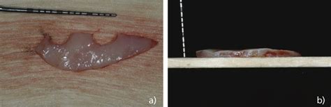 Microcirug A Aplicada A La Reconstrucci N Gingival Y Periodontal